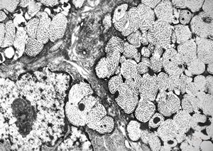 F, 75y. | skin metastasis of mucinous adenocarcinoma